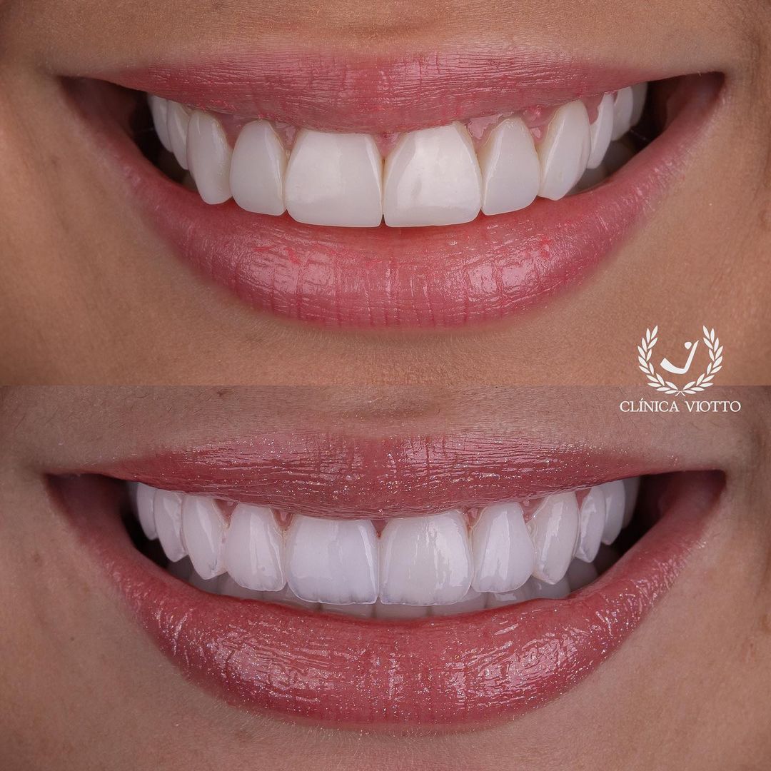 Antes e depois do sorriso de Larissa, do BBB23