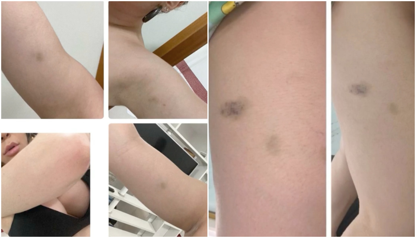 Naiara Azevedo incluiu no processo fotos de hematomas - e, com ele, conseguiu uma medida protetiva contra o ex-marido