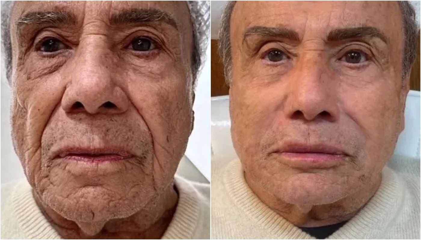 Stenio Garcia passa por harmonização facial